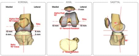 Fertige Planung für persönlich angepasste Knieprothese