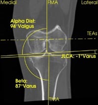 Schnittbild CT präoperativ Symbiosknie