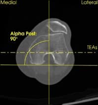 CT Bild präoperativ für Knieprothese