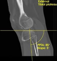 CT Bild Planung Knieprothese