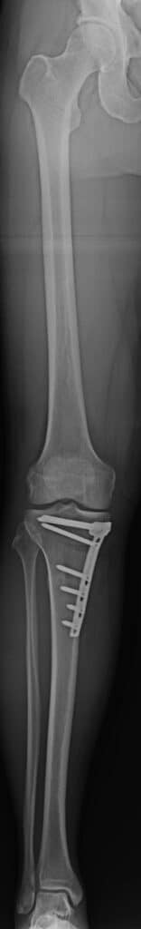 Varus-Fehlstellung (O-Bein)