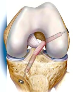 Vordere Kreuzbandplastik