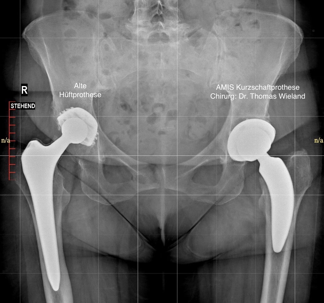 AMIS Hüfte Kurschaft