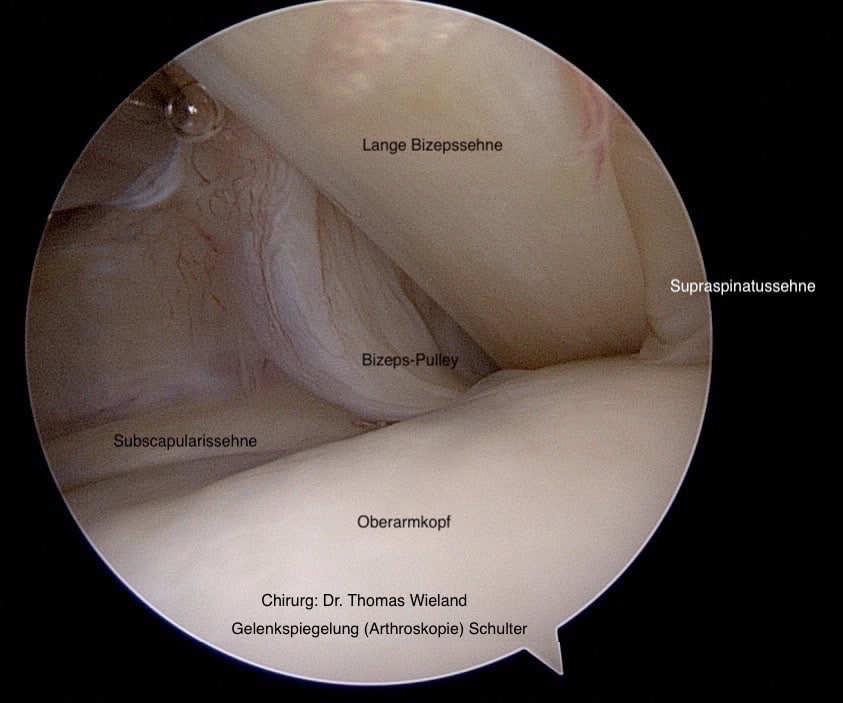 Bild zeigt eine arthroskopische Aufnahme einer Schulter