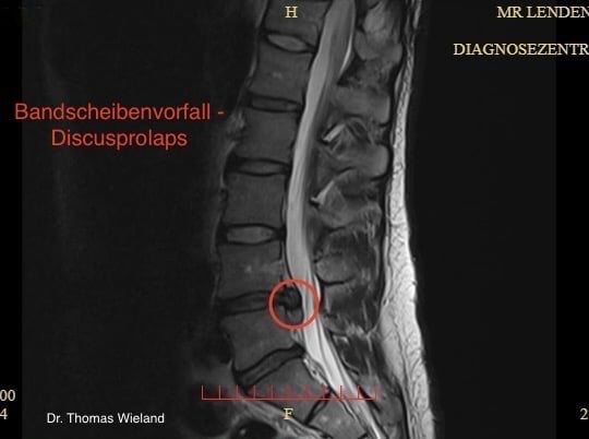 Das Bild zeigt einen Bandscheibenvorfall