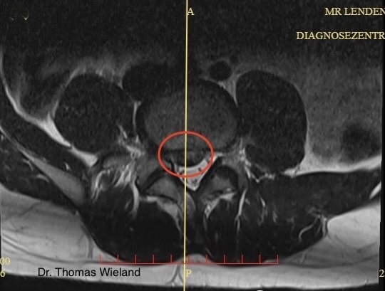 Das Bild zeigt einen Bandscheibenvorfall