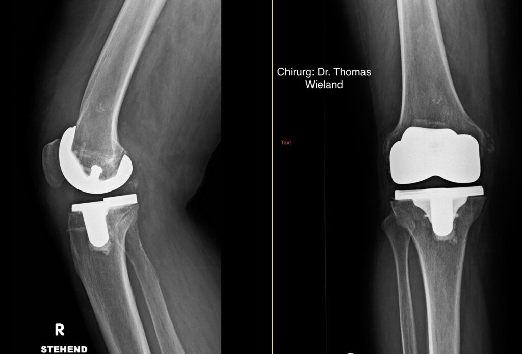 Knietotalendoprothese nach Maß Fa SYMBIOS