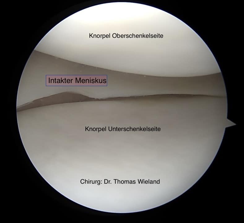 Bild zeigt eine arthroskopische Aufnahme eines gesunden Meniskus
