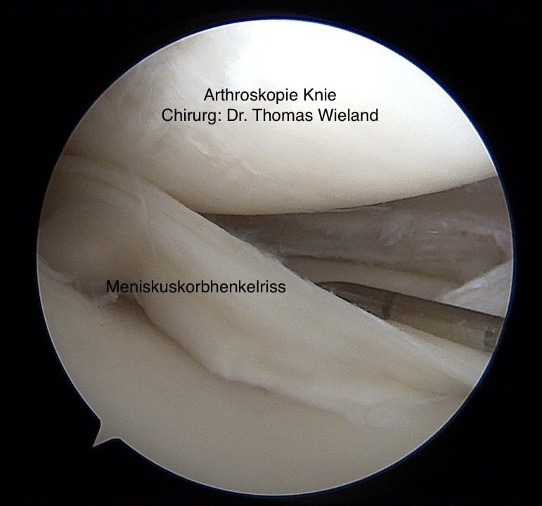 Bild zeigt eine arthroskopische Aufnahme eines Meniskuskorbhenkelrisses