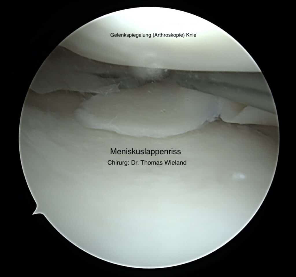 Bild zeigt eine arthroskopische Aufnahme eines Meniskuseinrisses