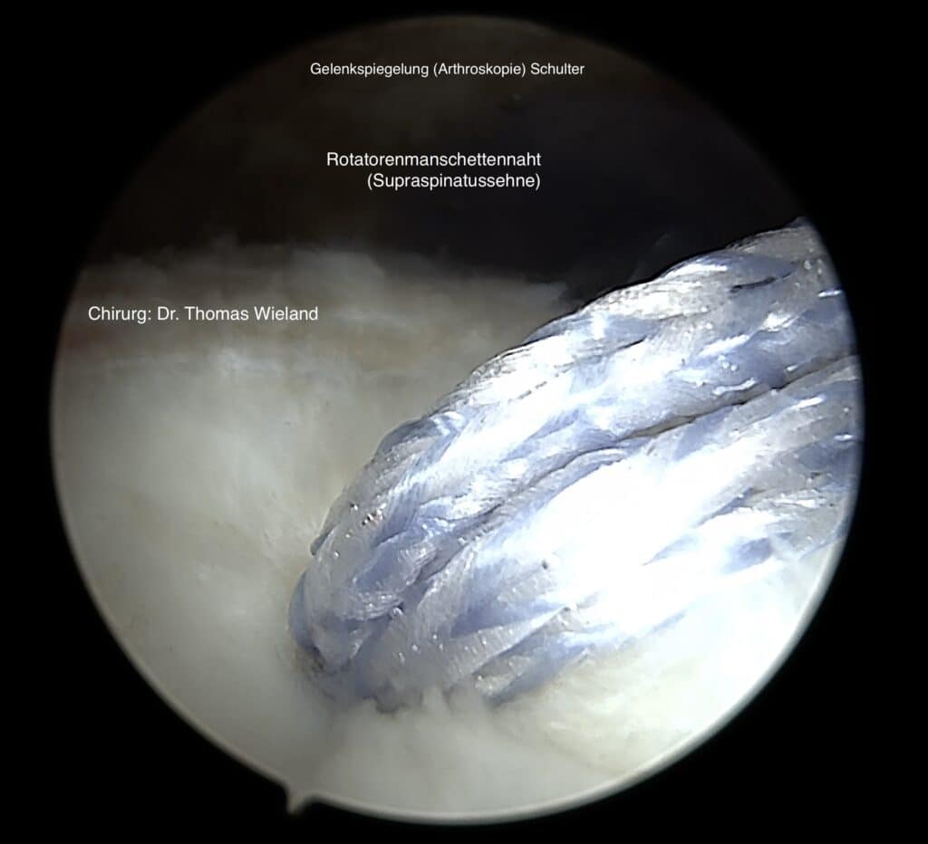 Arthroskopische Aufnahme einer Rotatorenmanschettennaht (Supraspinatussehne) der Schulter