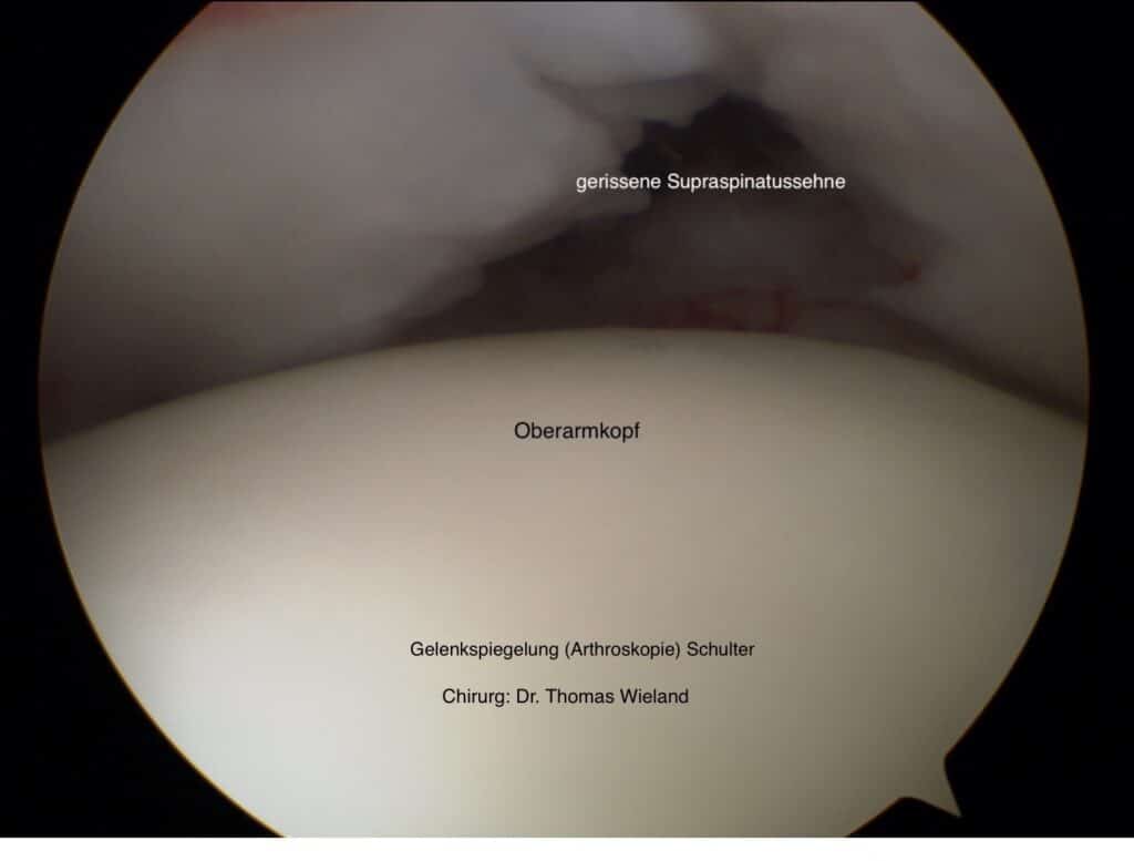 Arthroskopisches Bild eines Rotatorenmanschettenriss (Supraspinatussehne)