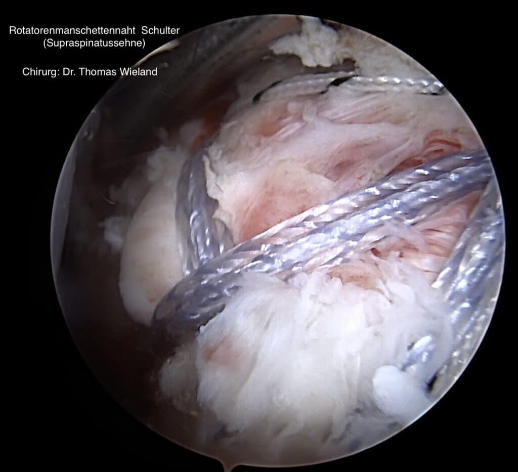 Bild zeigt eine arthroskopische Naht der Supraspinatussehne in der Schulter