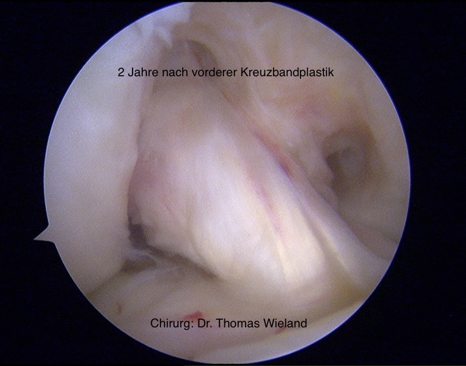 Arthroskopisches Bild zwei Jahre nach geheilter vorderer Kreuzbandplastik