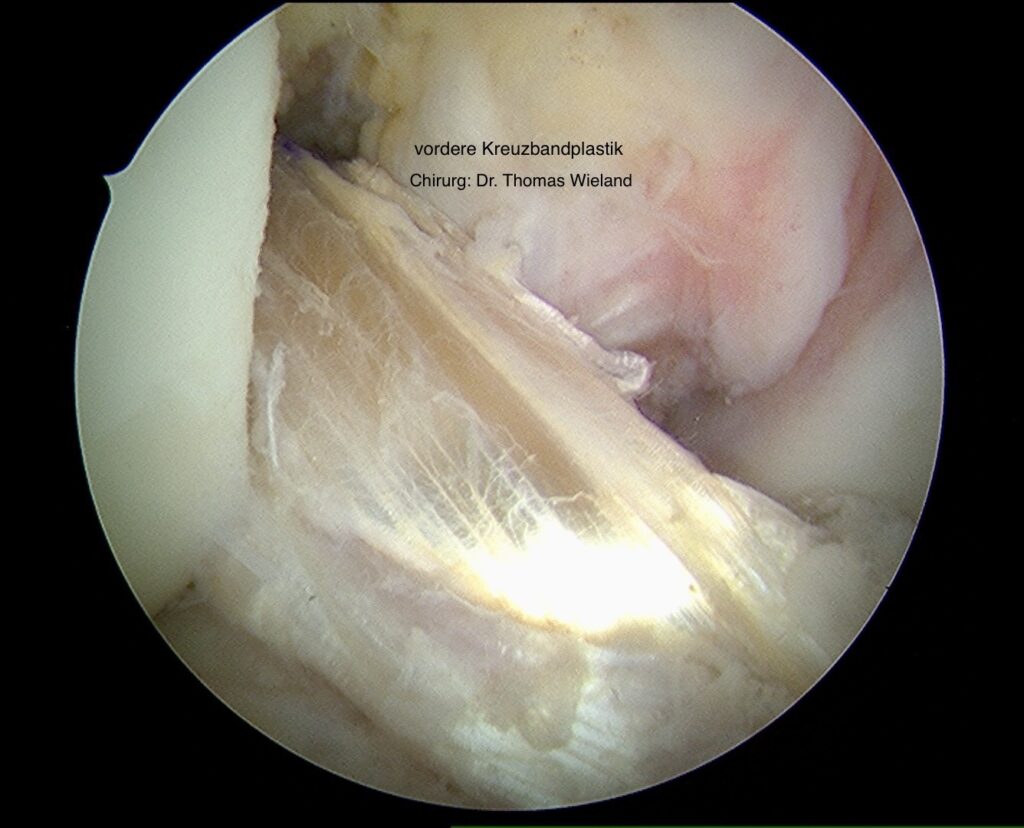 Arthroskopisches Bild einer vorderen Kreuzbandplastik