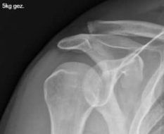 Luxation Schultereckgelenk mit Schlüsselbein-hochstand